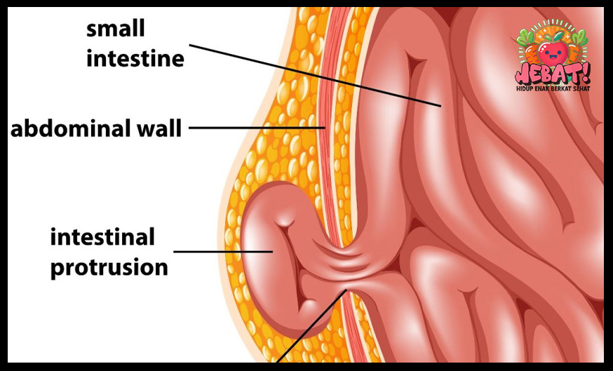 hernia