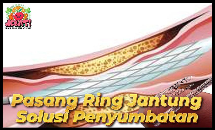 Pasang Ring Jantung, Solusi Penyumbatan Pembuluh darah